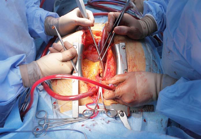 Cardiac and Cardiovascular Surgery Photo