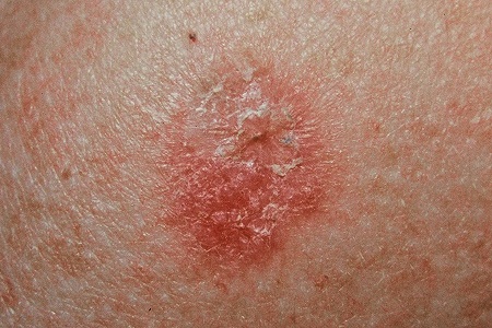 Non-Melanoma Skin Cancer | Global Events | USA| Europe | Middle East ...