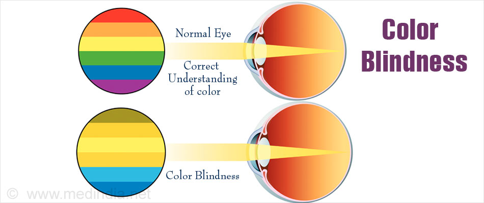can blue light cause color blindness