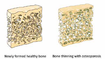 HIV and Osteoporosis Photo