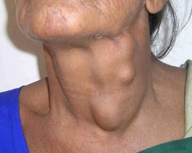 Head and Neck Cancer Photo