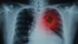 Lung Cancer Photo