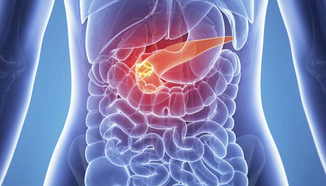 Pancreatic Cancer Photo